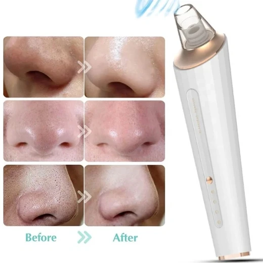 Generic Electric Blackhead Remover Pore Vacuum Cleaner USB Rechargeable with 3 Suction Modes for Deep Pore Cleansing - Generic - Image 3