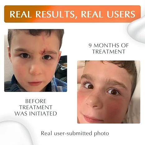 MyNewGel Plus UV Advanced Silicone Scar Gel | Old & New Scars | SPF30 Mineral non-chemical Sunscreen | Ideal for Protecting Scars | Harmful Ultraviolet Rays, 15g (0.5 oz) - MyNewGel - Image 5