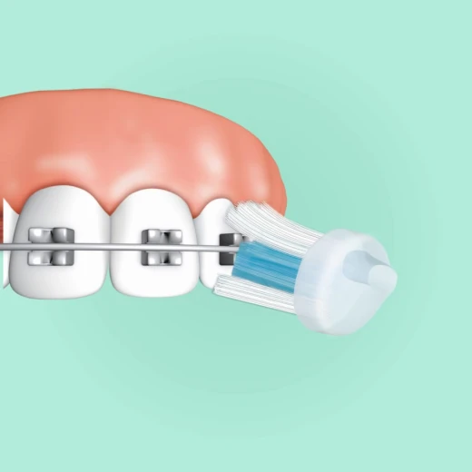 TRISA T.B. Bracket Clean TB - TRISA - Image 2