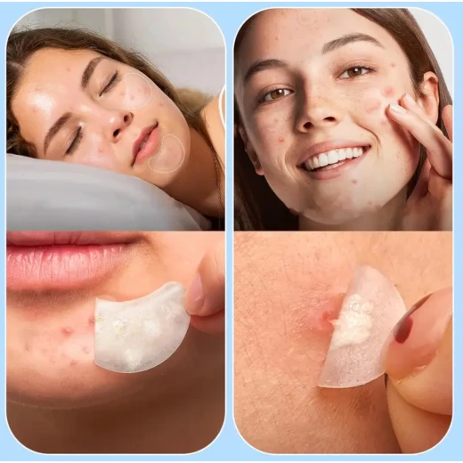 Hydrocolloid Acne Patches – 104 Pieces, 8 Sizes | Invisible Pimple Absorbing Stickers for Face & Body - Snugsy - Image 4